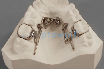 dispositivi ortodontici con miniviti